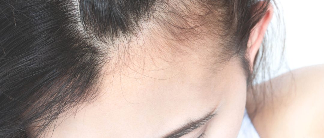 a woman suffering from thinning hair in london at the waterhouse young clinic